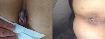 痔疮鼻炎无效退款，广西百色杨忠雅医师