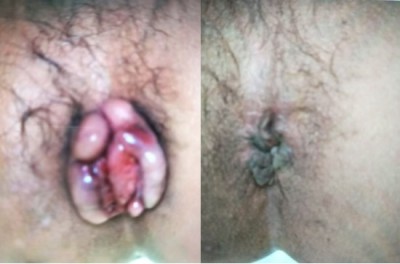 痔疮鼻炎无效退款，广西百色杨忠雅医师