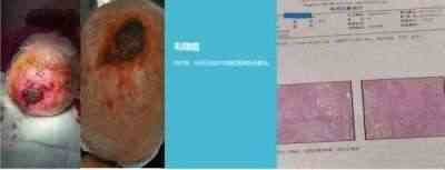 适温消融技术的临床应用