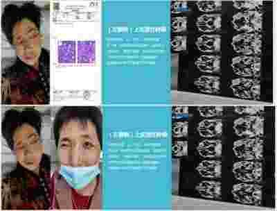 适温消融技术的临床应用