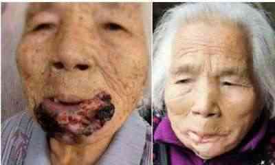 适温消融技术的临床应用